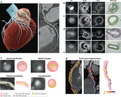 Clinical quantitative coronaryery stenosis and coronary ...