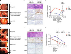 Fecal microbiota transplantation for refractory immune checkpoint ...