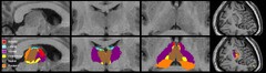 Morphological and metabolic asymmetries of the thalamic subregions ...