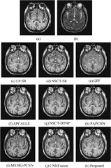 Medical fusion based on DTNP systems and Laplacian pyramid ...