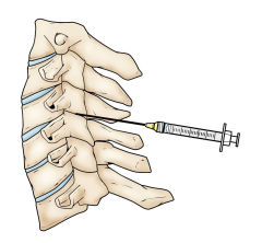 Cervical Radiculopathy (Pinched Nerve) - OrthoInfo - AAOS