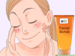 3 Ways to Remove the Redness of a Pimple - wikiHow