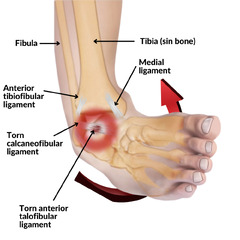 Can Chiropractic Care Help with Chronic Ankle Sprains? — ChiroUp