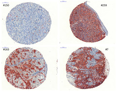 Cancers |-Text | Distinct Molecular Mechanisms of ...