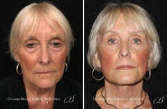 1 Facelift Plastic Surgeon | 34 Years Experience