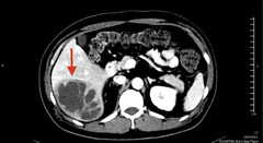 Pancreatic cyst