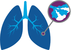 Genentech: Understanding Idiopathic Pulmonary Fibrosis